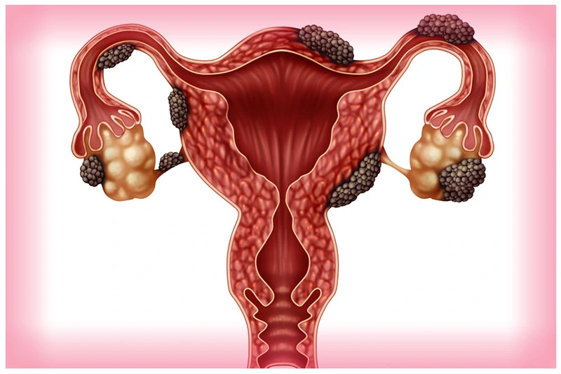 Genix Fertility Care | Baby Conceive in Bhubaneswar, Odisha >> Grade I endometriosis with patent Tubes